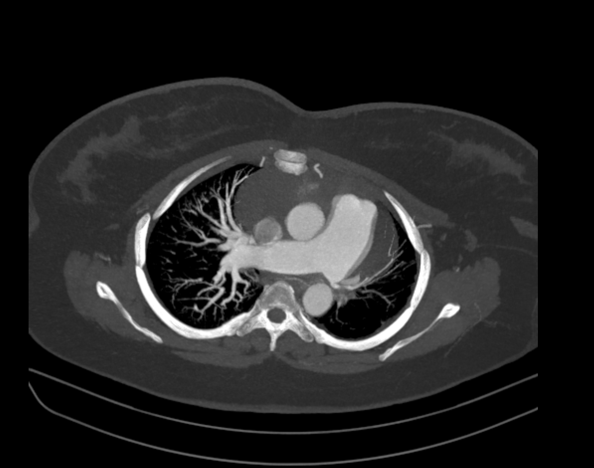 A 39-year-old female with a history of chest discomfort and persisting breathlessness