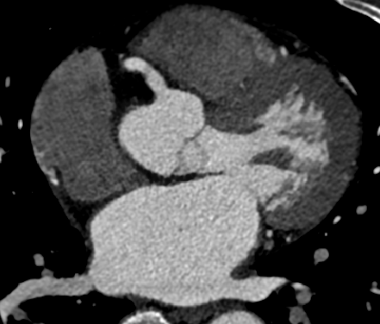 A 57-year-old male with atypical angina and a history of recurrent syncope episodes for 1 year