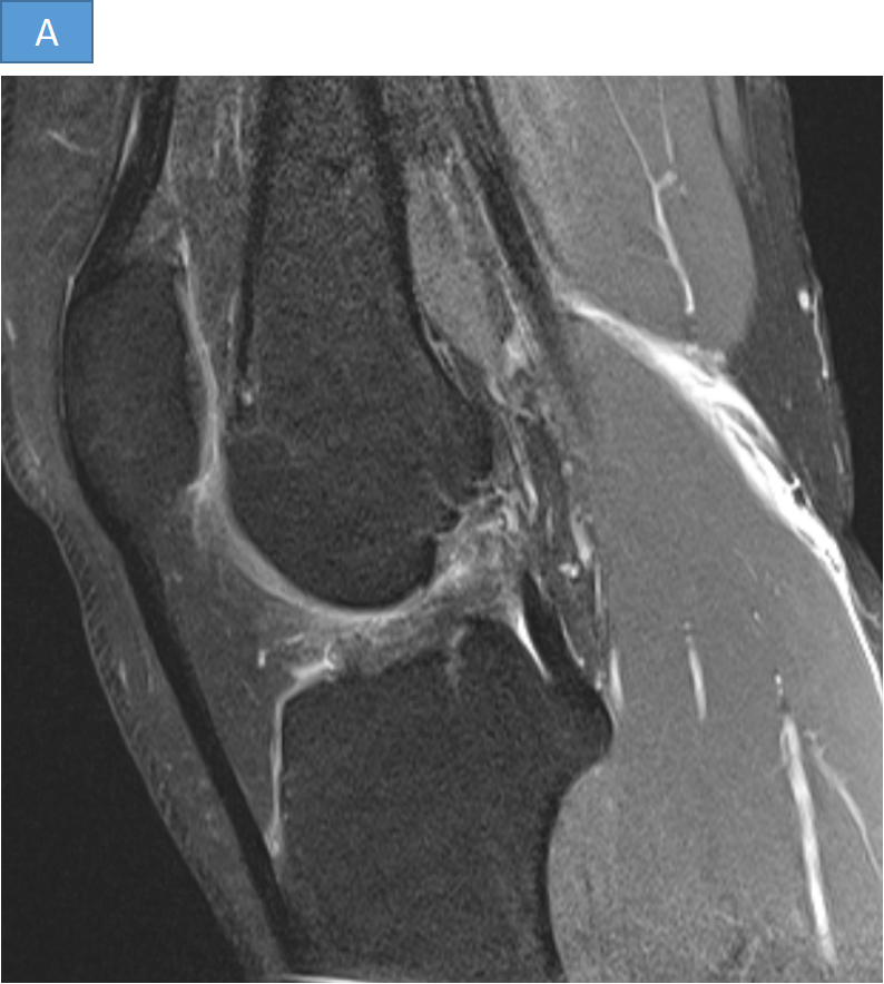 21-year-old male patient with a history of trauma to the knee while playing football 1yr back