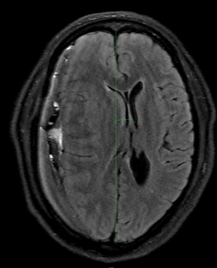 FINDINGS - MRI BRAIN WITHOUT IV CONTRAST
