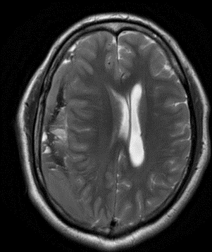 FINDINGS - MRI BRAIN WITHOUT IV CONTRAST
