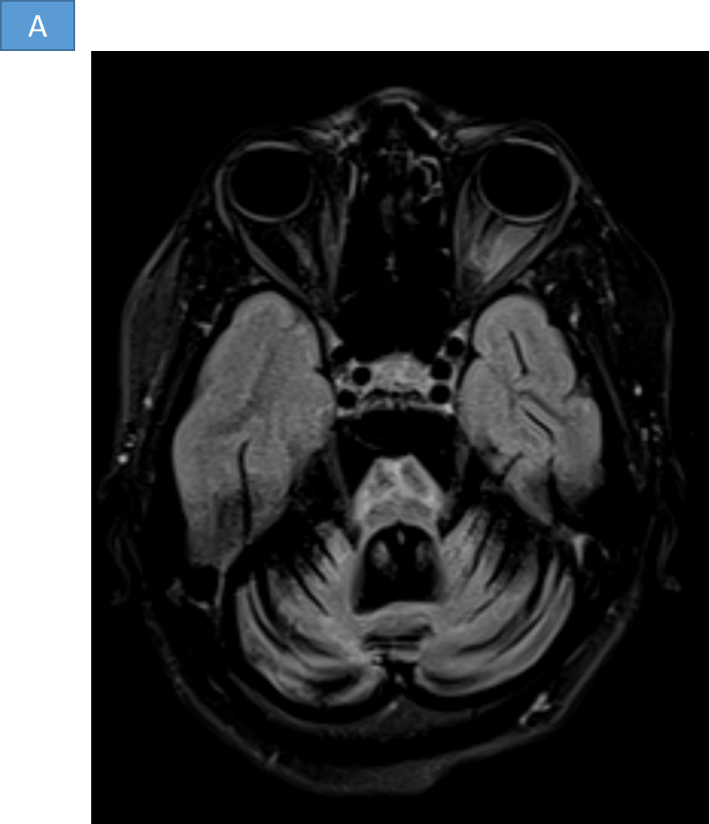 51  yr old female presented with chronic progressive ataxia.