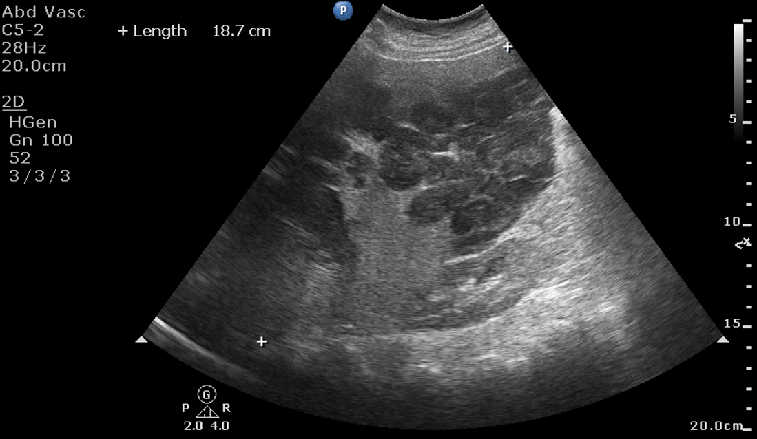 41 year old G2P1L1 female patient at 8 weeks of gestation with a history of decreased appetite and pain abdomen. Retroviral positive on ART. 