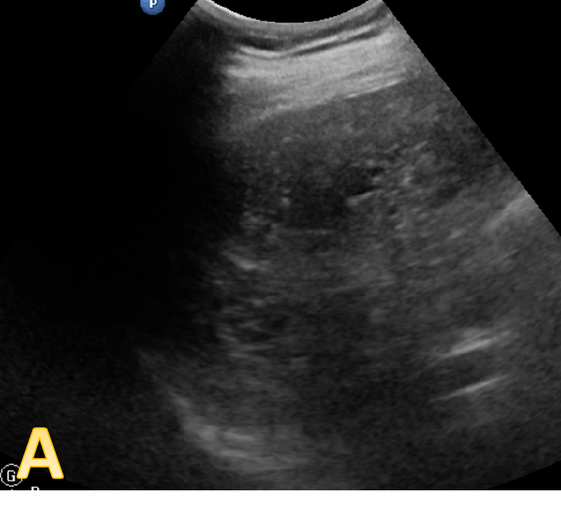 59 year old male – on routine health check with no active complaints. No jaundice or abdominal distension or pain or GI bleed. 