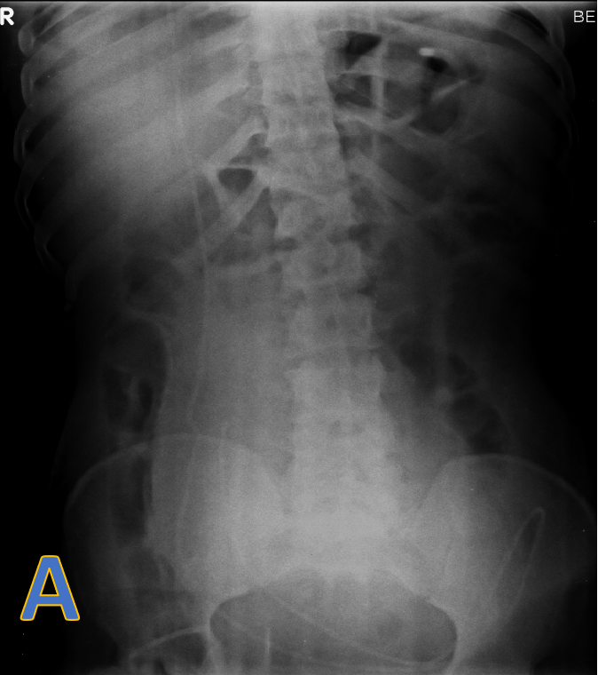 22 year old male with history of Road traffic accident -sustained subdural haemorrhage with 6 mm midline shift, craniofacial injuries, Pneumothorax, and pneumomediastinum