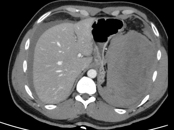 47-year-old male patient came with history of abdominal pain for 2 days History of trying summersault in the swimming pool, following which the patient developed abdominal pain