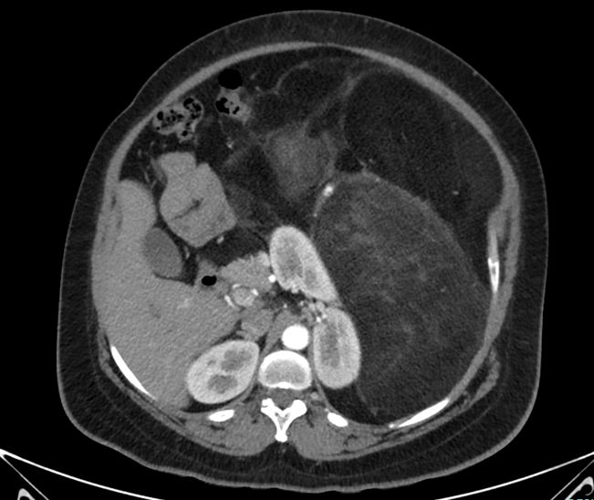 45 year old lady, with no known comorbidities presented with periumbilical swelling and generalized abdominal pain for 2 months