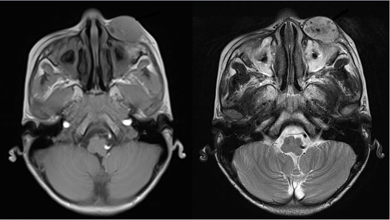 10-year-old boy presented with soft  non-tender compressible swelling in the left infraorbital region and the swelling increase in size while leaning forward