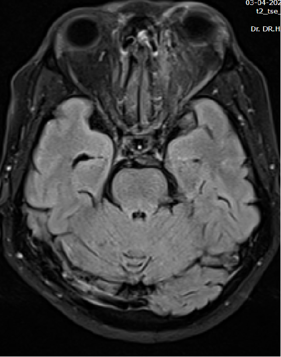A 45 year old male with complaints of pain and sudden loss of vision in left eye.