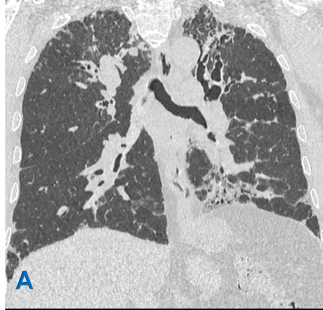 60 year old male with c/o dyspnea, cough, sinusitis