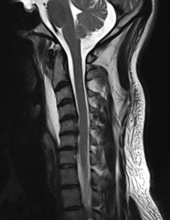 35 years old male Presented with neck pain and headache with Odynophagia since 5 days 