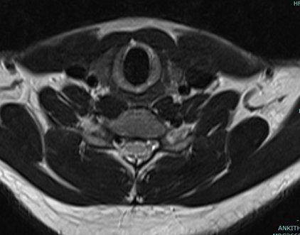 A 16 years old male presented with complains of reduced hand grip, reduced sensation over the medial aspect of little and ring fingers bilaterally(right>left) for the past 3 months on left and for the past 6 months on right.