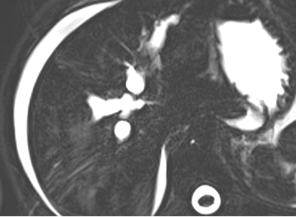 5 year old girl with abdominal pain and discomfort and one episode of fever spike