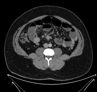 37 year old came to ER with c/o severe abdominal pain