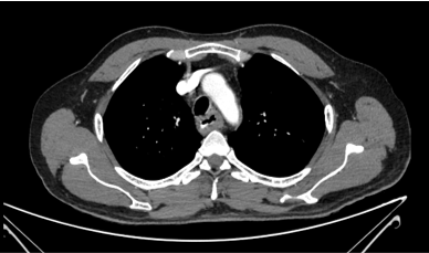 52 year old male presented with long standing intermittent and recurrent GI issues