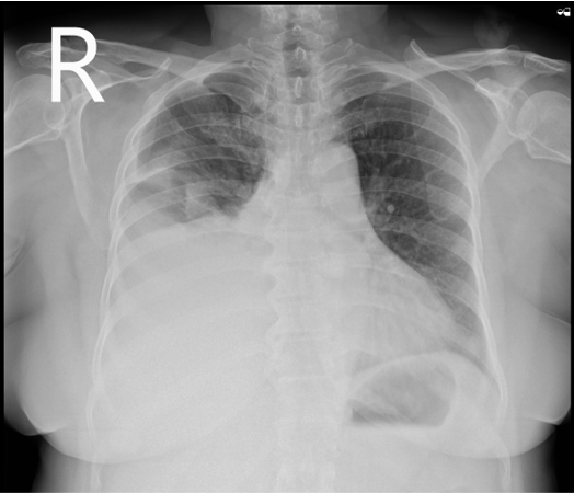 57 year old female presented with  dyspnoea on exertion since 1 month and Wheezing