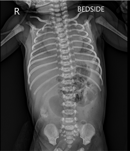 G2E1 with 37+5 weeks of gestation with PROM delivered male baby with antenatal scan showing