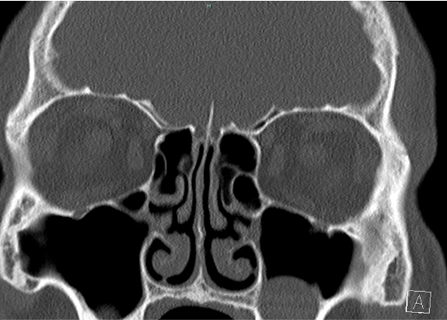 A 23 year old, male  presented with clear watery discharge from the left nasal cavity and history of fever,  severe headache and signs of meningitis.