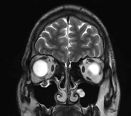 A 20 years old male patient presented with history of trauma to right eye followed by diplopia.