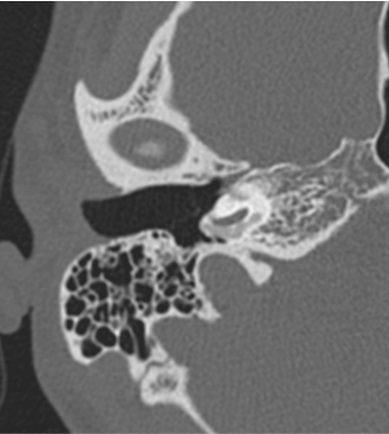 33 year old male with complaints of right sided hearing loss since childhood. 