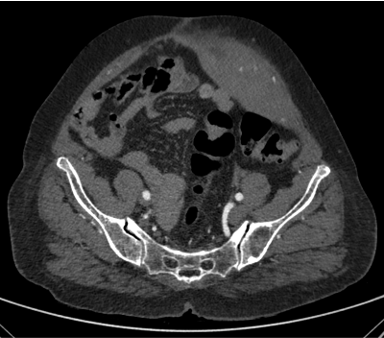 A 66 year old diabetic and hypertensive lady with one day history of abdominal pain which is progressively increasing in intensity.