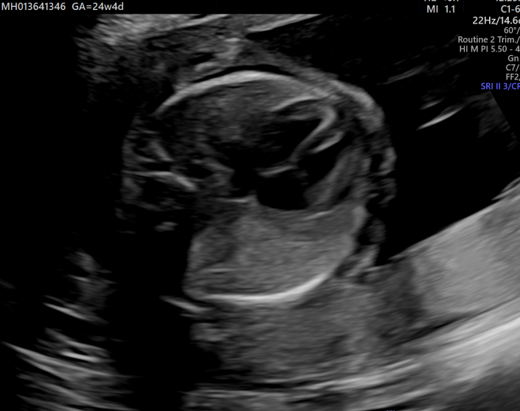 A three week old male infant presents with respiratory distress and sepsis since birth with suspected CPAM on antenatal ultrasound