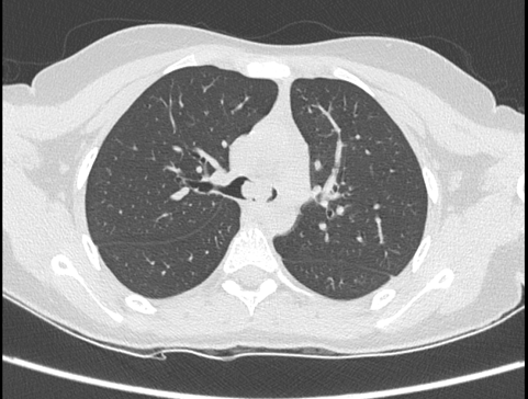 15years old female came with history of cough, shortness of breath and asthma.