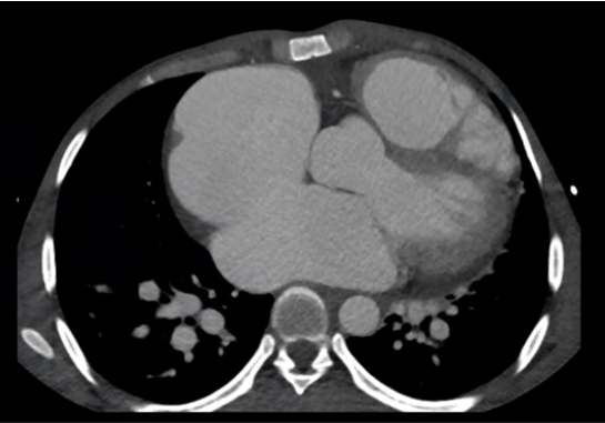 A 29-year-old male came with history of breathlessness