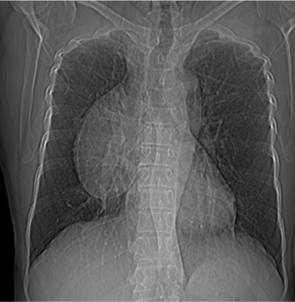 A 76 year old male patient presented with history of right sided chest pain for the past two months