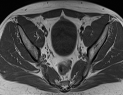 A 37 years old gentleman came with complaints of pain in left groin radiating to thigh for the past 4 months