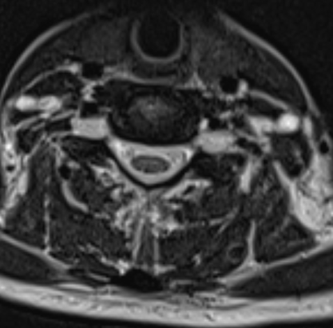 A 42 year old lady presented with progressive paraparesis