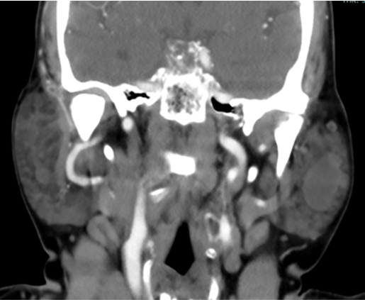 A 68 year old, female presented with complaints of decreased salivation and painless facial swelling (bilateral cheek region)