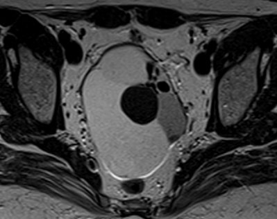 A 51-year-old lady (Para 2, Living 2) with history of hysterectomy and left salpingo