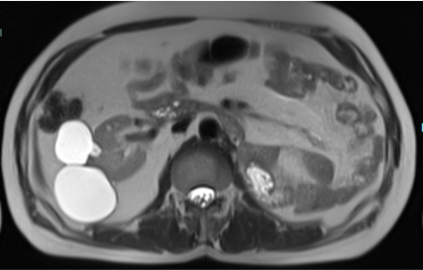 A 53 year old male, with history of previous left nephrectomy and right iliac fossa pain.