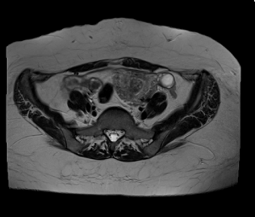 C/O heavy and frequent bleeding post MTP last month, no pain abdomen