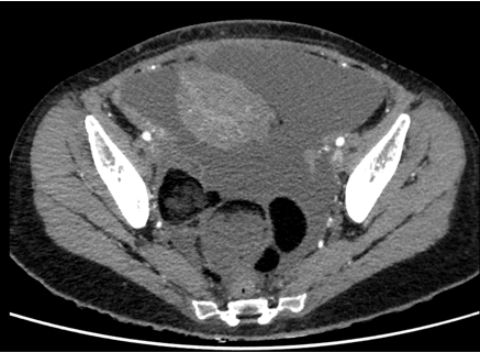 A 36 years old female,  7 days post-partum developed severe abdominal pain.