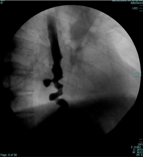 52 year old male with post prandial distress and bloating followed by abdomen pain and vomiting