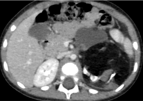 Incidentally noticed abdominal lump; no constipation, no urinary retention or any other complaints. Growth and development - normal