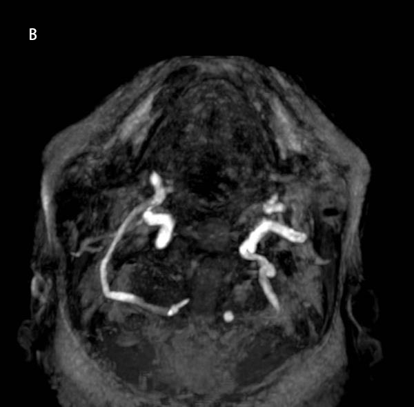 75y old male presented with numbness in right upper limb since 1 day associated with slurring of speech
