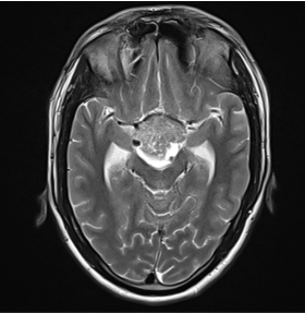 A 18 year old male,  History of headache since 1 month. Change of voice since 1 month.