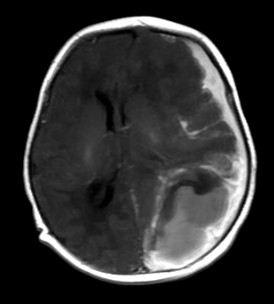 5 days old infant presented with history of seizure. History of prolonged difficult delivery present.