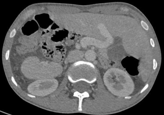 A 27 year old gentleman presented with few episodes of hemoptysis