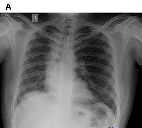 37 year old male presented with sudden loss of consciousness following nocturnal micturition with abnormal screening chest X- ray.