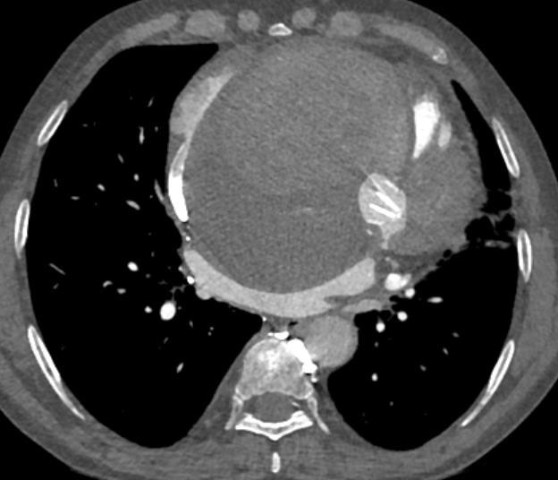 A 54 years old, male patient presented with complaints of swelling in the bilateral lower limbs and breathlessness