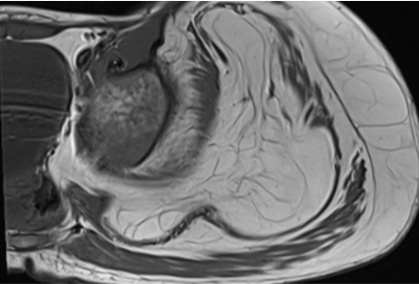 2 years old male presented with progressive disproportionate enlargement of left thigh, leg, foot and hand.