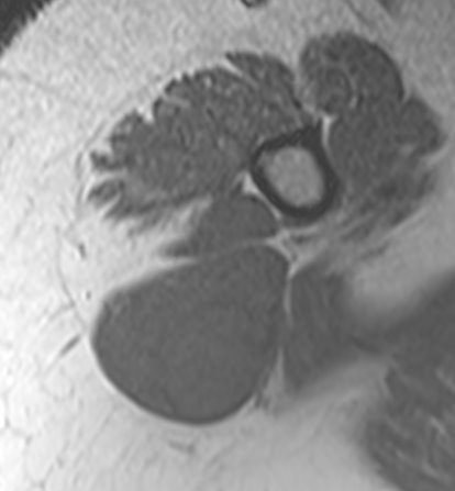 31 yr old female with history of right shoulder and upper arm pain, difficulty in lifting the arm.