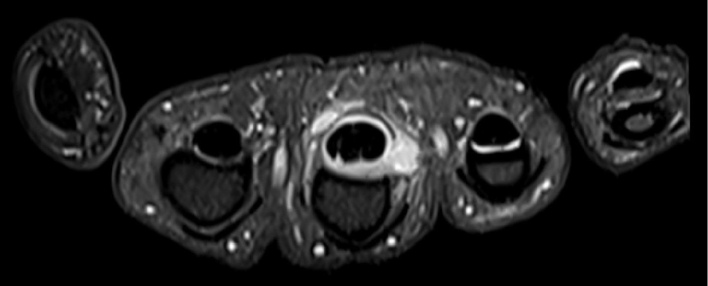 A 62-year-old gentleman presented with on and off swelling in the left middle finger associated with difficulty in folding the finger.