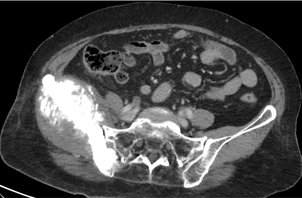 A 67 year old female, known case of previous Ca Cervix stage IV A. Underwent neo-adjuvant chemo followed by concurrent chemotherapy and radiotherapy 15 years ago. Now complains of right hip pain. 