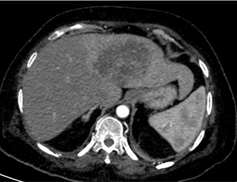 A 62 year old female, history of fever and abdominal pain.