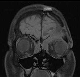 A 52 year old male presented with complaints of pain on left side of face radiating to head Recurrent seizure (last episode 3 years ago), on medication.